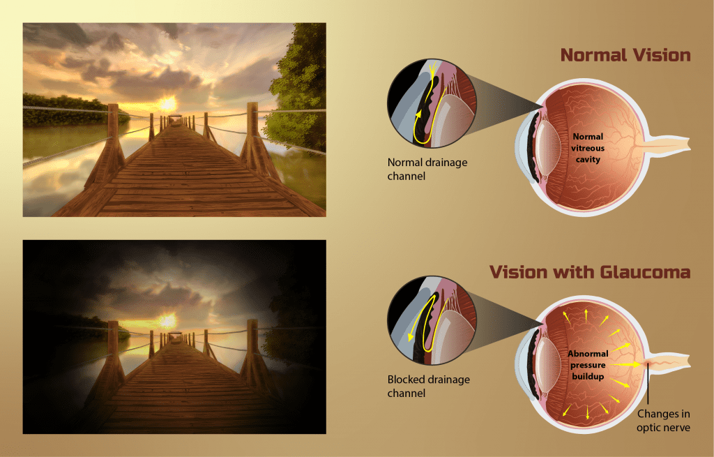 Diagram showing the difference between regular vision and vision with glaucoma. 